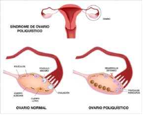 imagen demostrativa de la formacion de ovarios poliquisticos