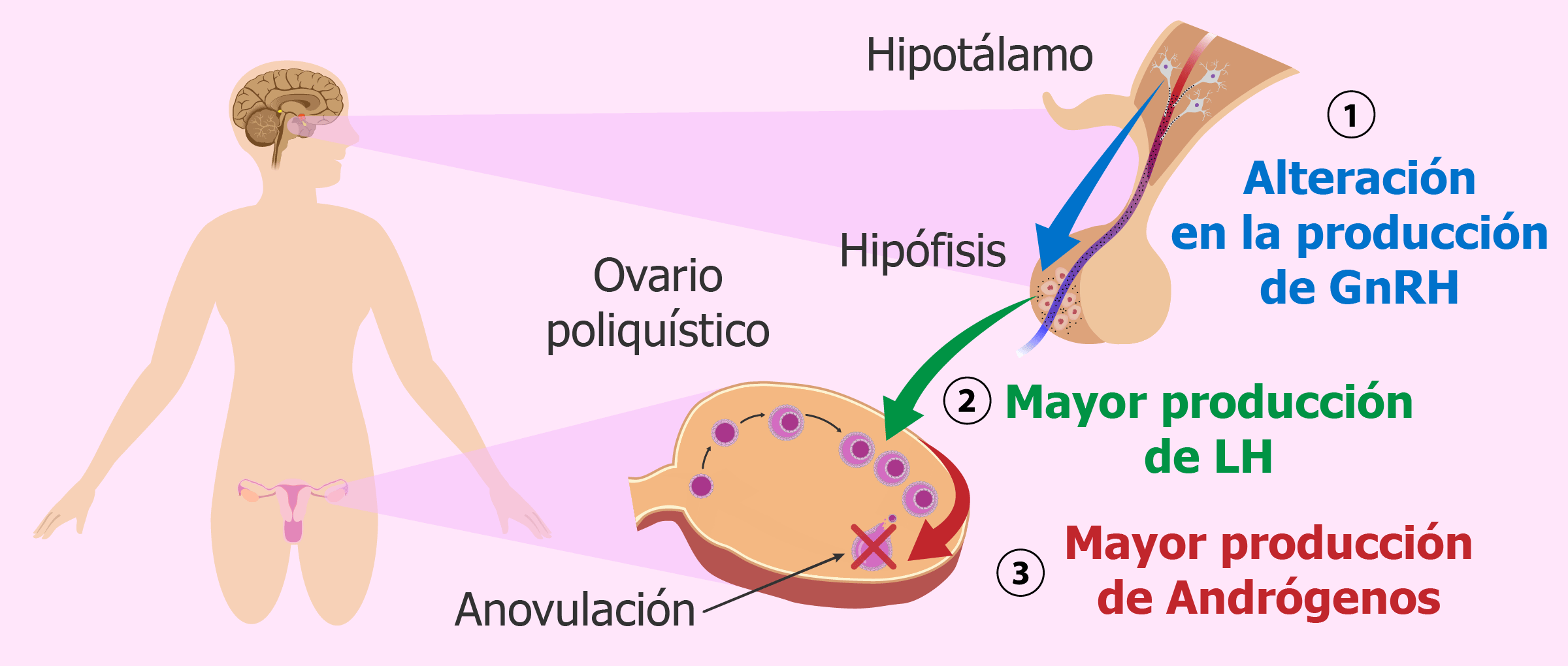 (c) Ovarios-poliquisticos.com