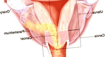 endometriosis - endometriosis biodescodificacion 390x200