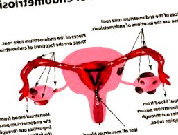 endometriosis - endometriosis complicaciones