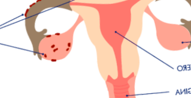 endometriosis - endometriosis despues del parto 390x200