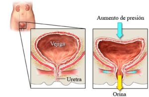 La incontinencia urinaria es también un síntoma muy común del cáncer de ovario