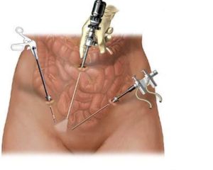 Muchos médicos realizan una técnica llamada LOD, también conocida como perforación ovárica laparoscópica.